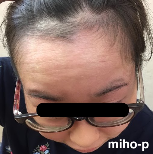 滲出液を伴う慢性皮膚炎の改善例 美保薬局 福島県いわき市の皮膚病お悩み相談専門の経験豊富な薬局です