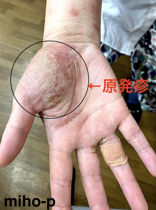自家感作性皮膚炎（じかかんさせいひふえん）の改善例