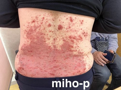 尋常性乾癬(じんじょうせいかんせん)の改善例