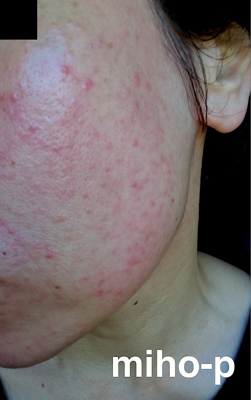 「酒さ(しゅさ)」の改善例